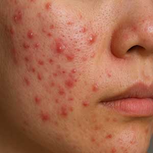 ニキビ肌荒れ